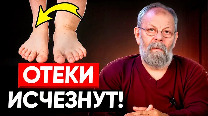 5 упражнений от ВАРИКОЗА. Лечение без лекарств и операций! Доктор медицинских наук.